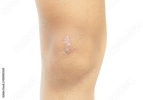 Scar on the boy's knee, Boy 11 years old isolate on white backg