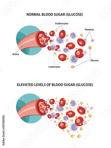Artery and diabetes