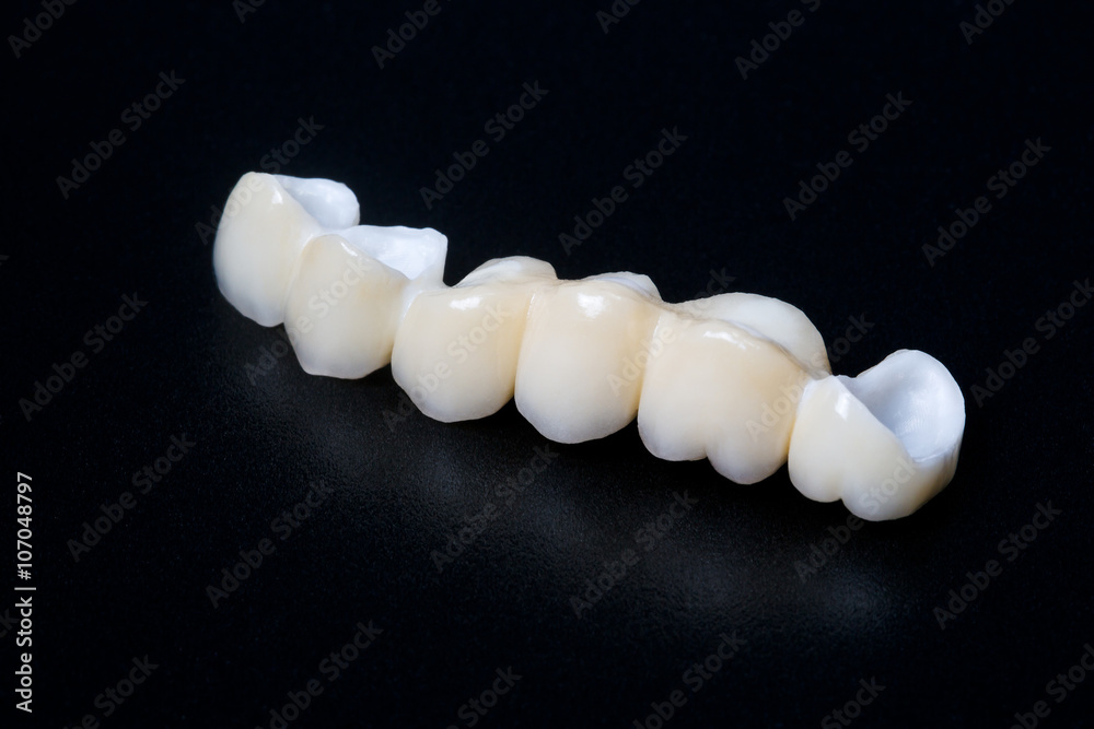 Fototapeta premium Puente de cerámica de zirconio 