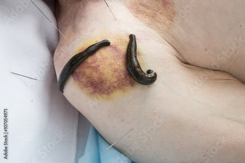 Treatment of medical leeches people and acupuncture. photo