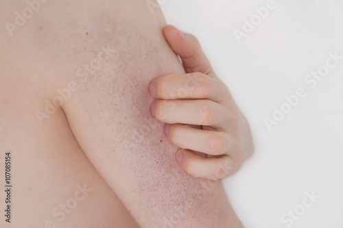 Nahaufnahme eines jungen Mannes mit Keratosis Pilaris