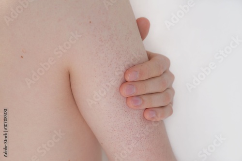 Nahaufnahme eines jungen Mannes mit Keratosis Pilaris