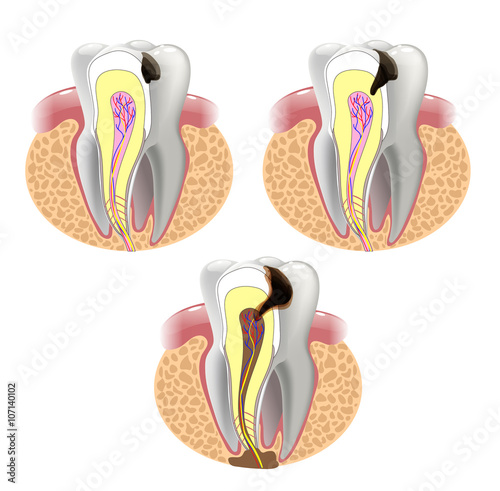 THE STAGES OF CARIES DEVELOPMENT