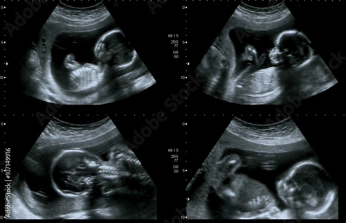 Medical images collage of ultrasound during woman pregnancy show