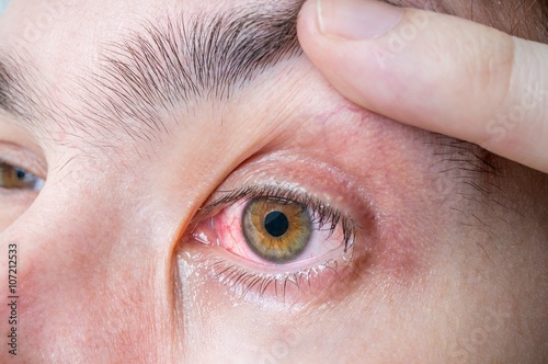 Принти на полотні Irritated and injured red eye.