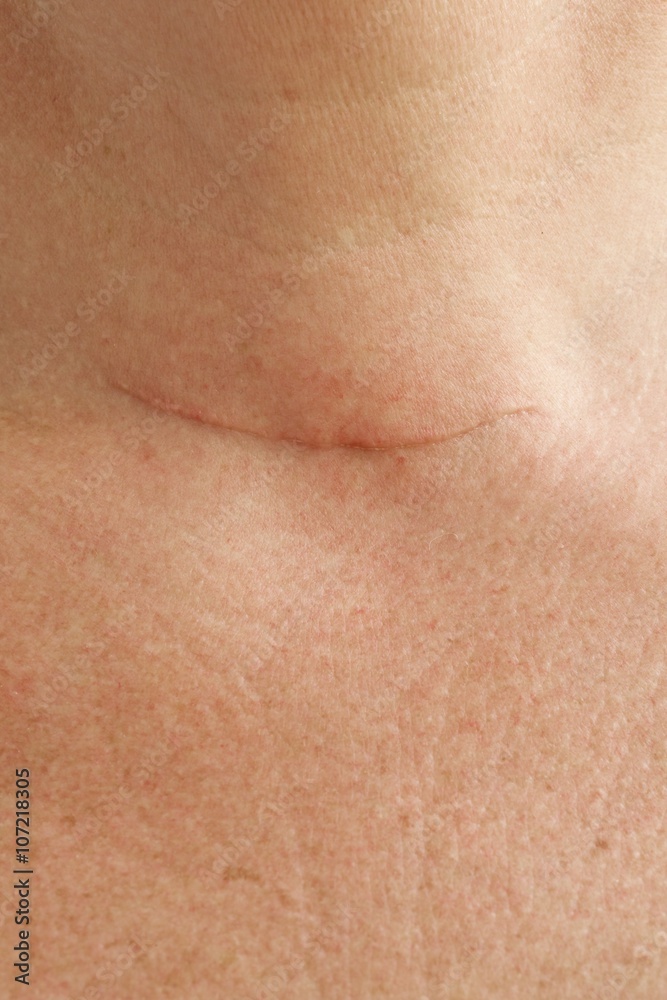 Neck scar after thyroidectomy.Closeup