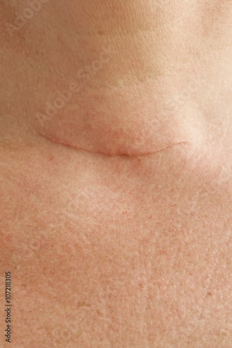 Neck scar after thyroidectomy.Closeup