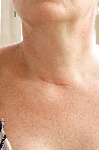 Canvas Print Neck scar after thyroidectomy.Closeup