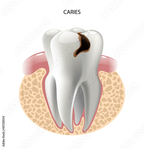 vector image tooth caries disease