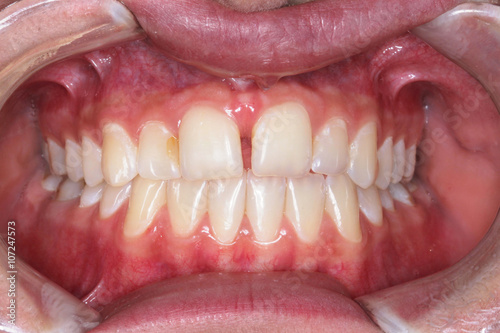 Gebiss Zähne frontal 1 