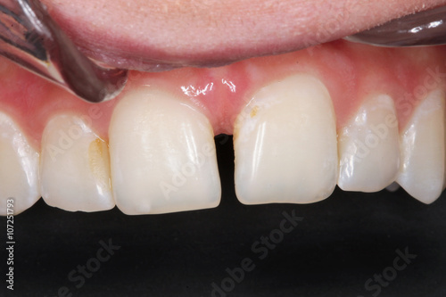 Gebiss Frontzähne Zahnlücke Zahnheilkunde 