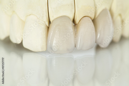 Foto Metal free ceramic dental crowns