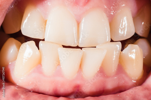 Close-up of a female mouth with crooked teeth and malocclusion photo