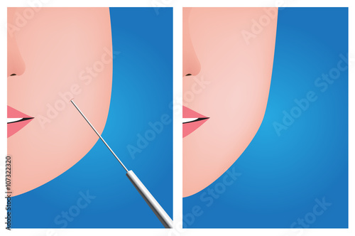Face liposuction , before after