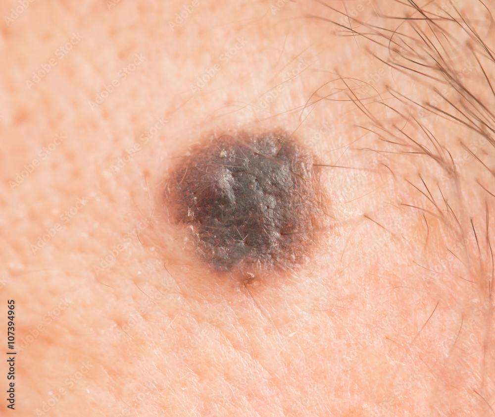 black mole on the skin Stock Photo Adobe Stock