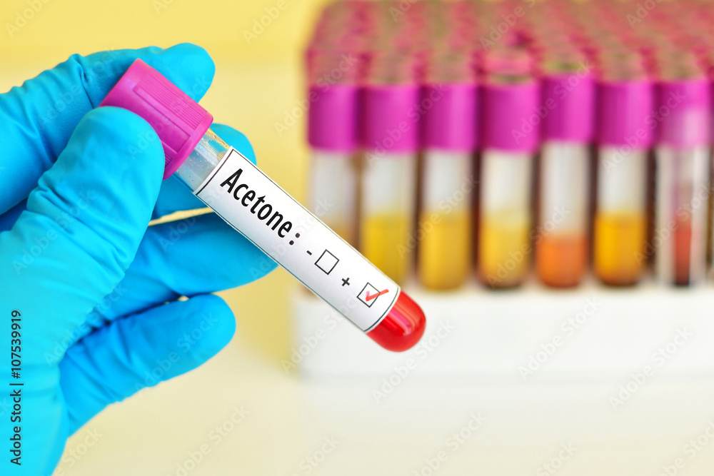 Naklejka premium Blood sample positive with acetone chemical testing 