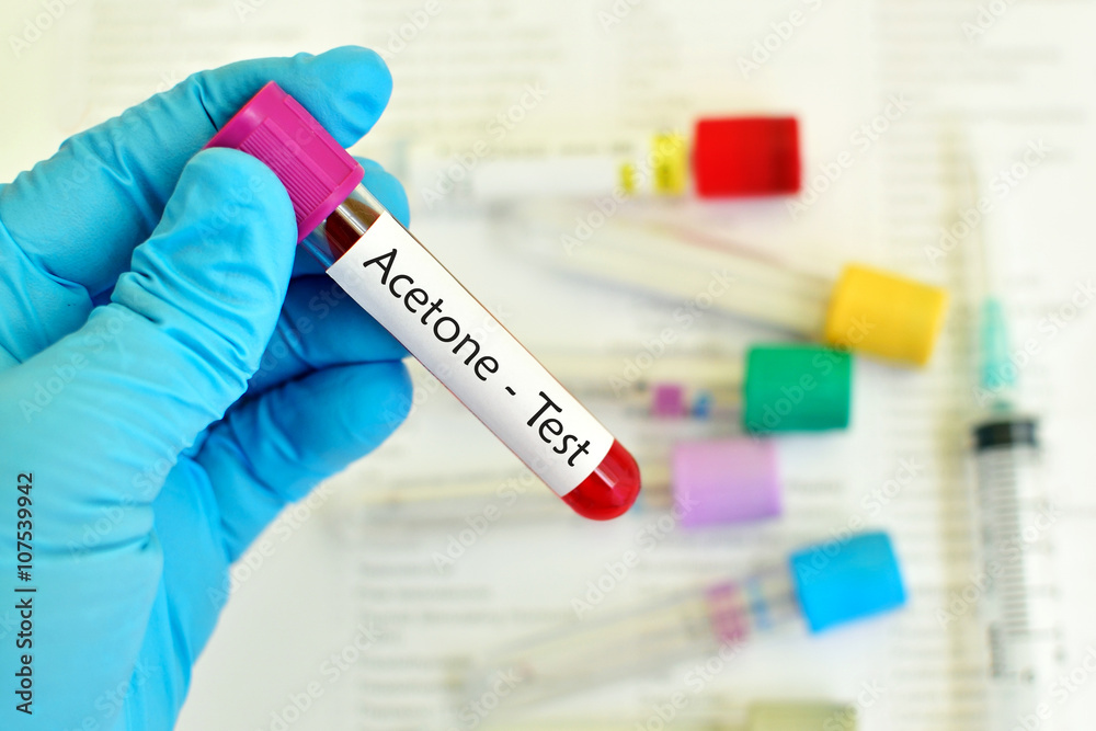 Naklejka premium Test tube with blood sample for acetone test 