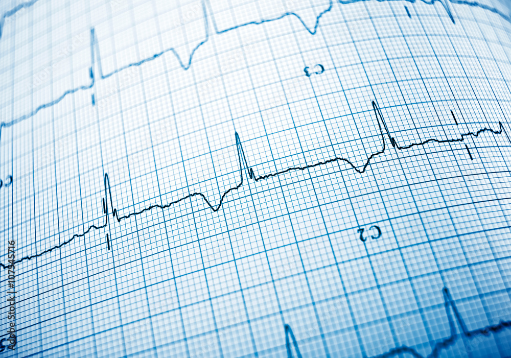 Electrocardiogram Electrocardiogram