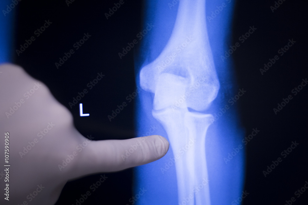 Foto Stock Tennis elbow joint xray scan | Adobe Stock