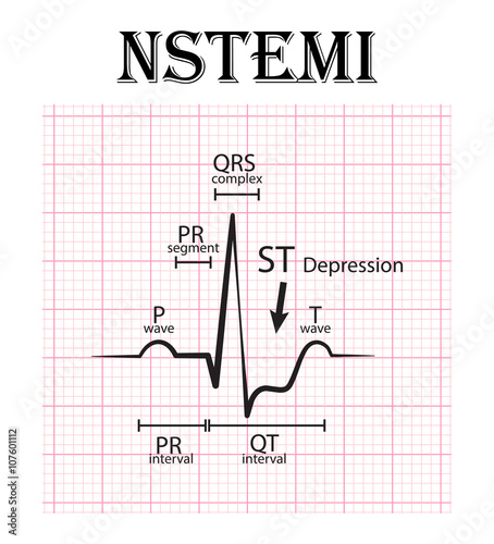 ECG of non ST elevation myocardial infarction (NSTEMI) and detail of ECG ( P wave , PR segment , PR interval , QRS complex , QT interval, ST depress , T wave) Acute coronary syndrome , angina pectoris