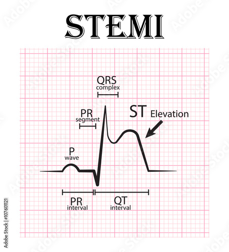 ECG of ST elevation myocardial infarction ( STEMI ) and detail of ECG ( P wave , PR segment , PR interval , QRS complex , QT interval , ST elevate , T wave )  Acute coronary syndrome , angina pectoris