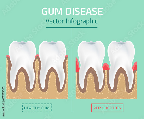 Teeth infographic Gum disease stages