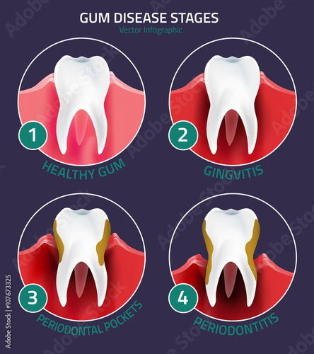 Teeth infographic Gum disease stages