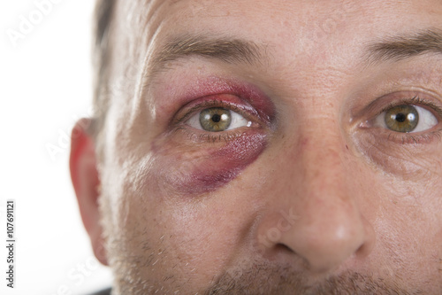 Φωτογραφία Middle-aged Caucasian male Emotional Portrait with a Real Bruise