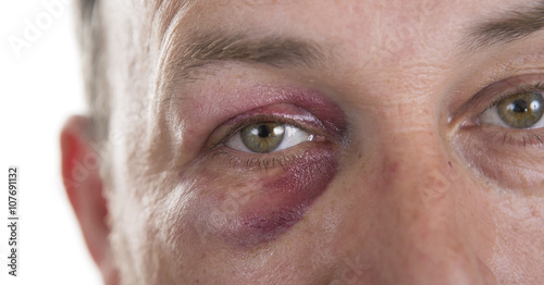 Middle-aged Caucasian male Emotional Portrait with a Real Bruise photo
