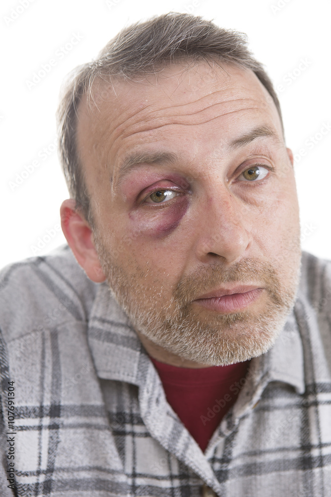 Middle-aged Caucasian male Emotional Portrait with a Real Bruise Middle-aged Caucasian male Emotional Portrait with a Real Bruise