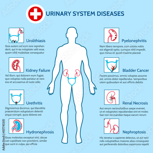 Urinary system diseases. Medical infographics of urinary system vector illustration