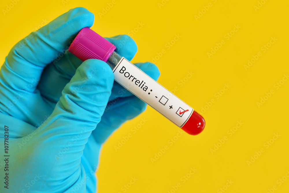 Obraz premium Blood sample positive with Borrelia test (Lyme disease diagnosis)