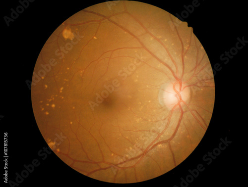 Human eye anatomy, retina, optic disc artery and vein etc. takin photo