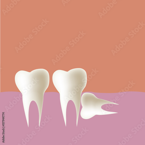 Wisdom tooth (Horizontal) in mouth, Vector illustration.