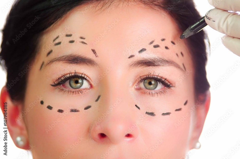 Closeup headshot caucasian woman with dotted lines drawn around eyes looking into camera, preparing cosmetic surgery