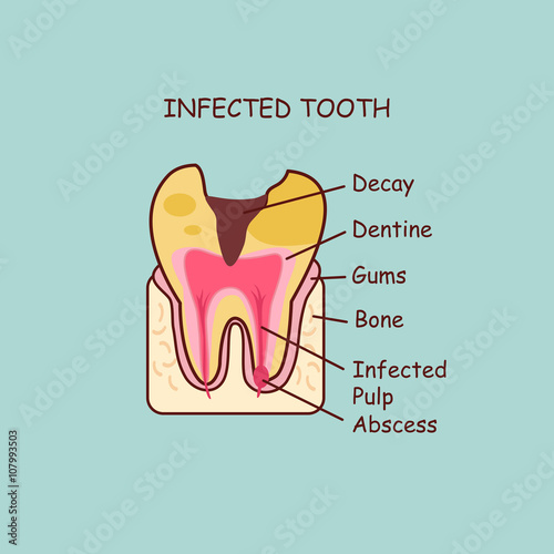 infected tooth concept