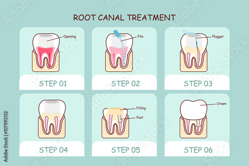 cartoon tooth root canal treatment
