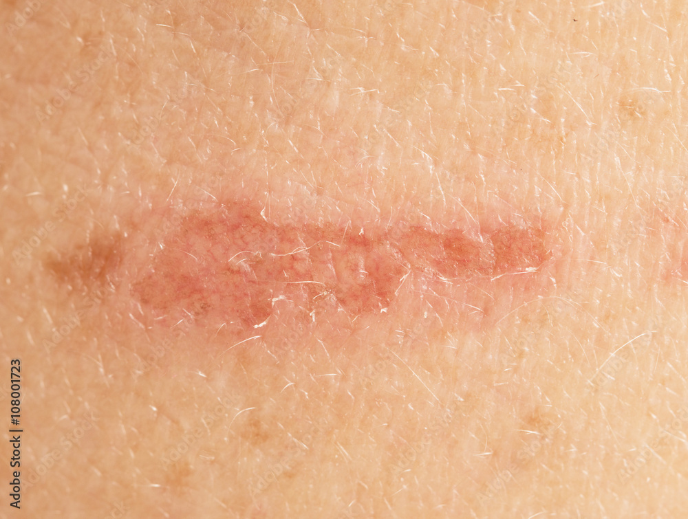 Fototapeta premium scratch on the skin close-up