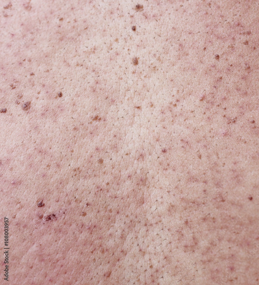 Girl with problematic skin and acne scars in the back Girl with problematic skin and acne scars in the back