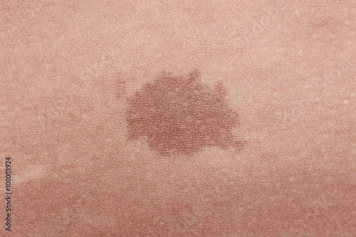 Close-up of brown birthmark photo