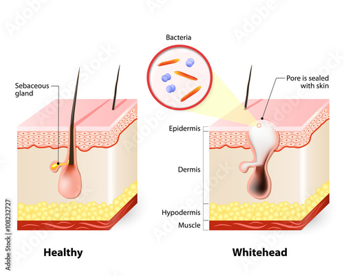 Healthy skin and Whiteheads