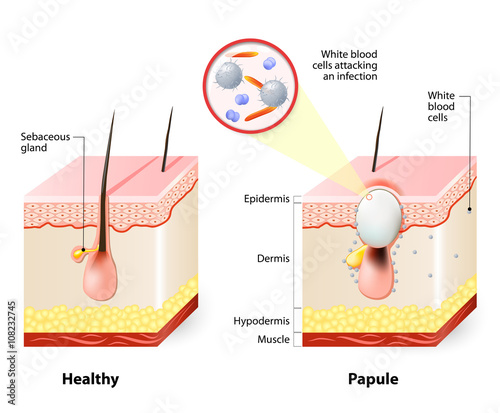 Healthy skin and Papules