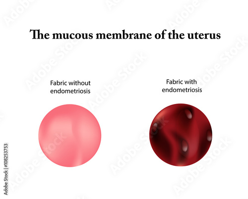 Endometriosis.  Adenomyosis. The endometrium. Vector illustration on isolated background