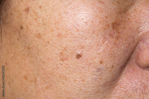 Close up Dry face skin with freckles, acne photo