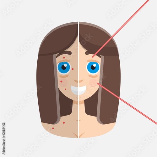 laser peeling before & after