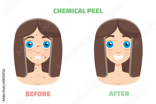 Chemical peel