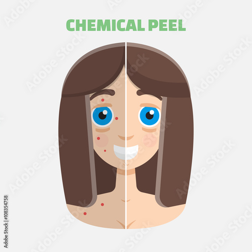 Chemical peel