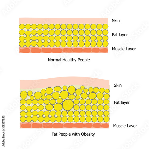 Fat people with obesity display by infographic