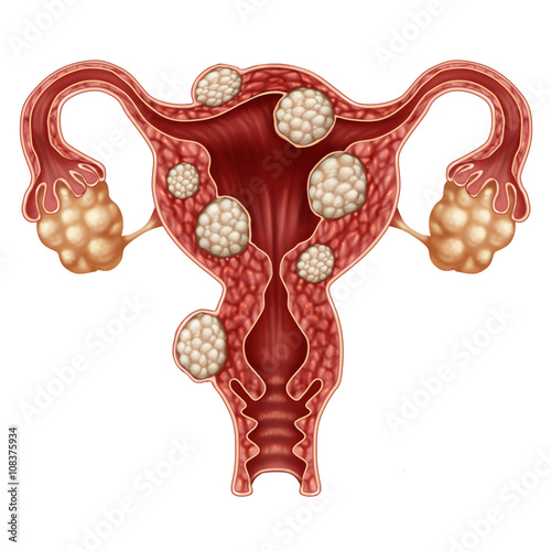 Uterine Fibroid photo