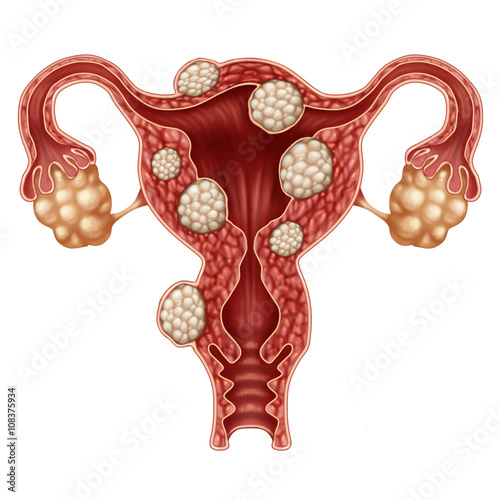 Uterine Fibroid